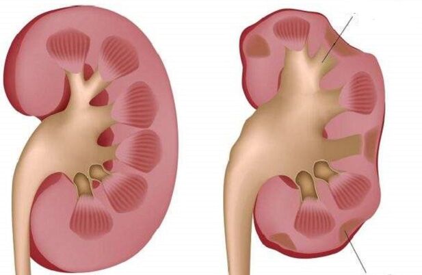 Healthy and diseased kidneys when drinking alcohol