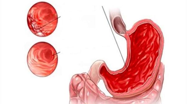 The damage of drinking to the gastric mucosa